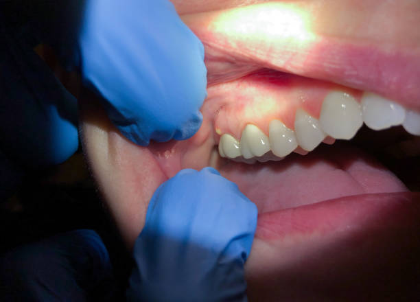 Best Chipped Tooth Repair Near Me  in Baden, MD
