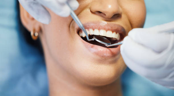 Emergency Dental Filling Replacement in MD